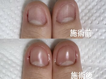 深爪矯正、初回の様子