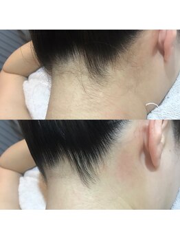 トラット エステアンドアイズ(tratto)/20代　お客様症例写真