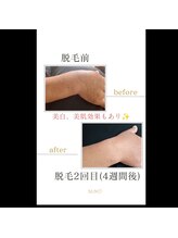 サンハート(SUN HEART)/ひじ下脱毛