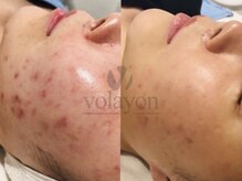 イヨヨ(iyoyo)/BeforeAfter