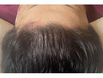 ボニータ(Bonita)/(ヘッド)ヒト臍帯幹細胞エステ