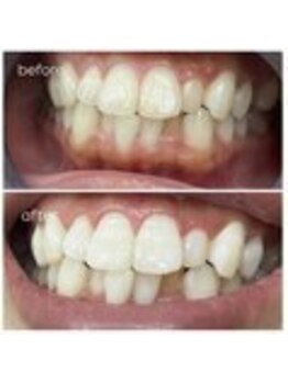 エクシアホワイトニング 津駅前店/お客様ビフォーアフター