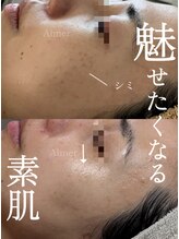 エメ(Aimer)/肌改善フェイシャル