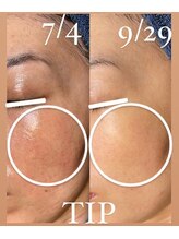 ビーピー 渋谷(b.p.)/ハーブピーリング