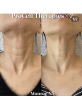 クラティス(CRATIS)/プロセルお首ケア