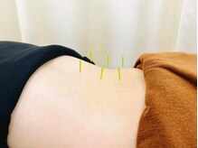 スポーツラボ鍼灸接骨院(スポーツLab鍼灸接骨院)/鍼施術