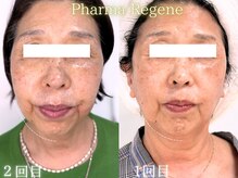 レイネ(REINE)/ファーマリジェネ/美肌三大要素