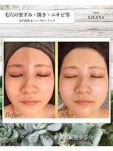 ウィズリリナ 新横浜(with Lilina.) 毛穴黒ずみ 開きニキビ