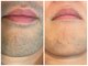ヴィセラ(Vicella)の写真/<脱毛STARTにお勧め◎>お肌に優しい"医療提携脱毛"で痛みの心配いらず♪脱毛しながら美肌ケアも出来る！