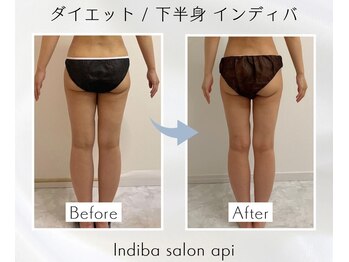 アピ(api)/症例写真【痩身インディバ】