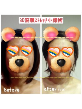 ビューティサロン キヨの部屋(beauty salon)/【３D筋膜ストレッチ小顔術】7回