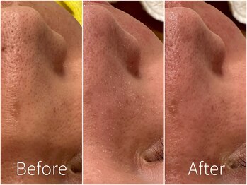 ビヨンド リンク(BEYOND L'INK)/韓国式3D毛穴洗浄