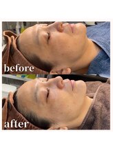 おうちサロン しゅろ/光フェイシャル