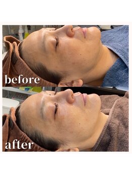 おうちサロン しゅろ/光フェイシャル