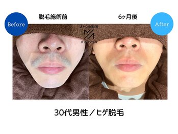 サロンアメリ イオンモール綾川店(Salon Ameri)/香川　脱毛　メンズ脱毛