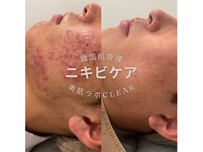 美肌ラボ クリア(clear)の写真