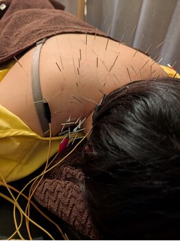 カンワ美容鍼灸院(KANWA美容鍼灸院)/頑固な肩こりは鍼で解消