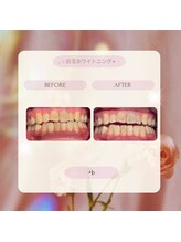 プラスビー 2号店(+b)/ホワイトニングビフォーアフター