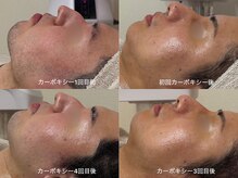 二重顎・メンズ特有の輪郭のゴツゴツ感・肌管理もお任せ下さい☆