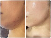 ラヴィ(Ravi)/フェイスライン緩み/ニキビケア