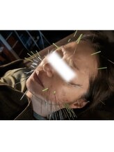 あいこ鍼灸院/天使の100本美容鍼