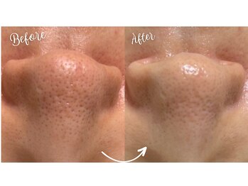 ユキエル(yukielle)/ビフォーアフター