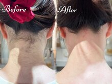 ピミル(PIMIL)/うなじ脱毛