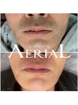 エアリアル 筑紫野店/第一印象を変えるヒゲ脱毛！