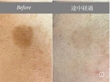 カミーシャ(KaMi-Sha)/【50代女性】シミケア症例写真