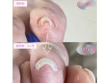 まき爪晴れる/