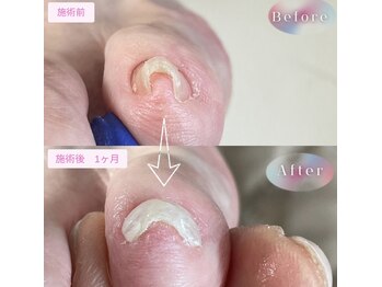 まき爪晴れる/