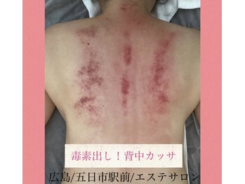 ルネティルタ 五日市駅前店(RUNE Tirtha)/背中カッサ