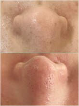 マヴィ 高槻店(MavY.)/1番人気は毛穴ケア