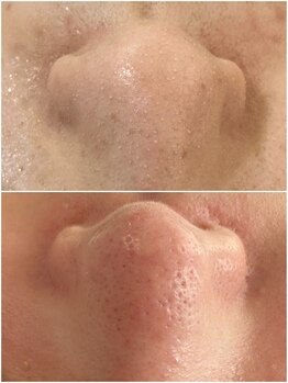 マヴィ 高槻店(MavY.)/1番人気は毛穴ケア