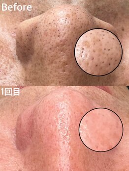 グラーティア 奈良王寺店/毛穴洗浄★1回後★