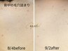 脱毛の相乗効果◎《背中超美肌Elight脱毛》×《超音波ピーリング》肌診断付♪