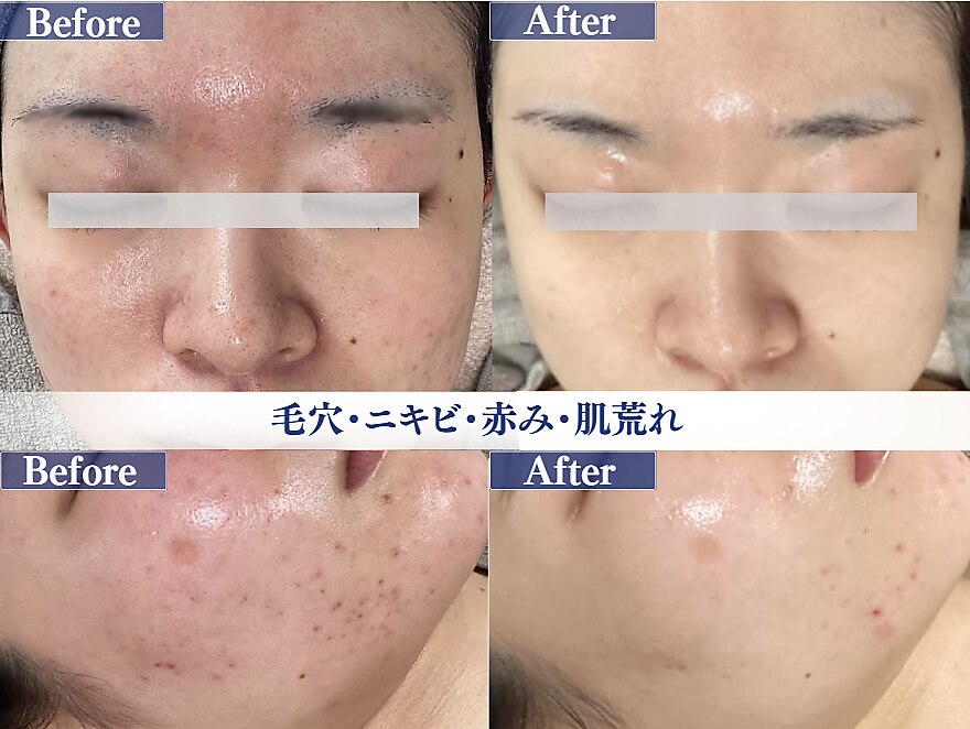 富山市で美白エステが人気のエステサロン｜ホットペッパービューティー