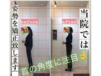 秋田桜トータルケアセンター/姿勢矯正のビフォー・アフター