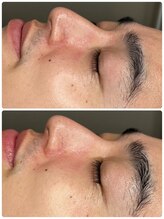 ラディアント 吉祥寺/メンズLALAピールツヤ肌