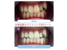セルフメイド イオンタウン防府店(SELF MADE)の雰囲気（医療提携セルフホワイトニング8回コースビフォーアフター）