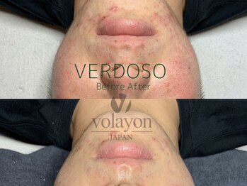 イヨヨ(iyoyo)/BeforeAfter