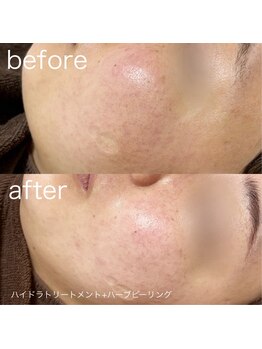 ルルラ リコ(lulula rico)/症例写真/ハーブピーリング