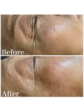 アルメ(arme)/【シワ・エイジングコース】