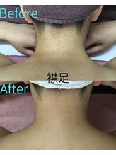 ベルミーランド MEGAドン・キホーテ桐生/脱毛　Before→After