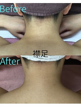 ベルミーランド MEGAドン・キホーテ桐生/脱毛 Before→After