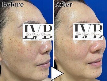 ラヴレボーテ(La Vraie Beaute)/40代・しみ シワ・改善期間5ヶ月
