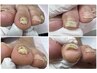 他趾(人差し指~小指)【分厚い爪再生補正 1爪】