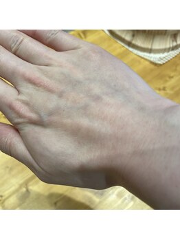 ナノハナ/鹿沼市の全身脱毛のナノハナ