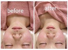 シャインクラフト/ハイパーナイフフェイシャル