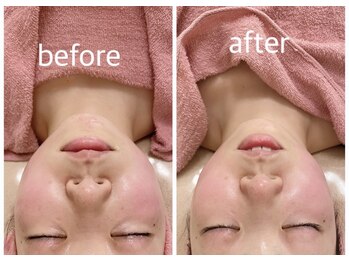 シャインクラフト/ハイパーナイフフェイシャル